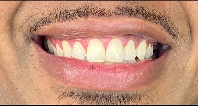 Faceta em Resina !  - Foto 2