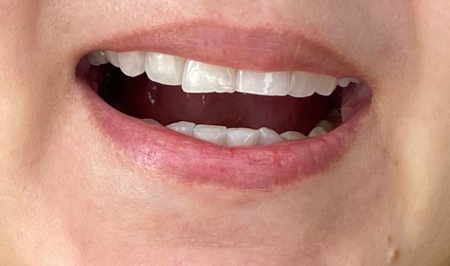 Faceta em Resina !  - Foto 4