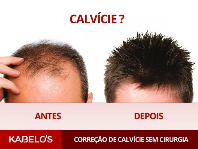Correção de Calvície sem Cirurgia