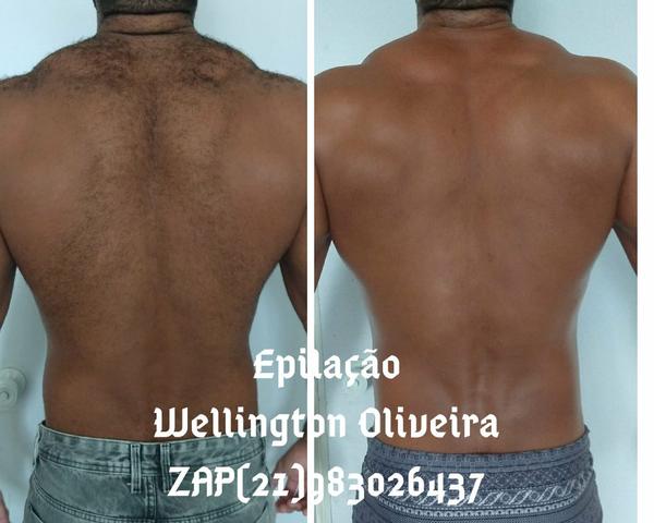 Depilação Masculina - Centro - RJ