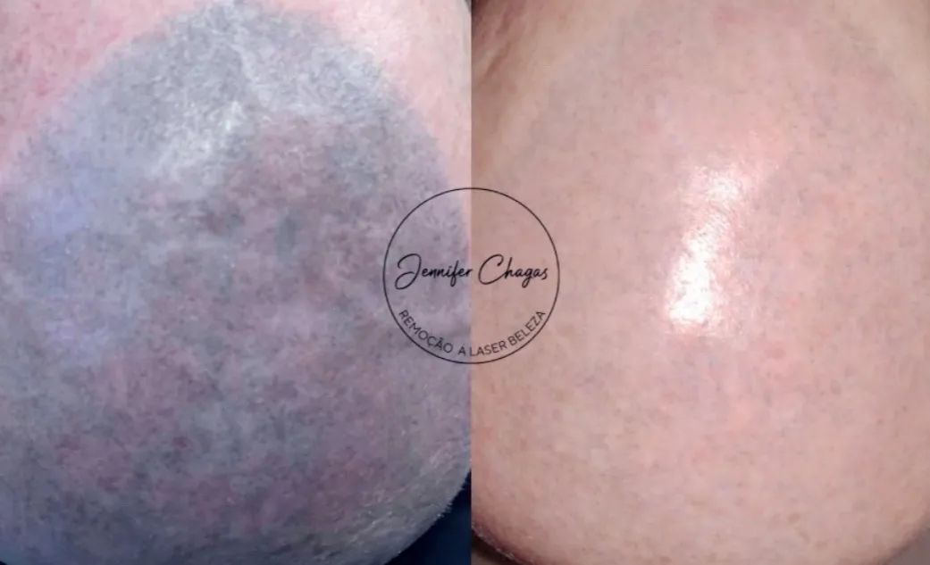 Remoção a laser de micropigmentação e tatuagem  - Foto 3