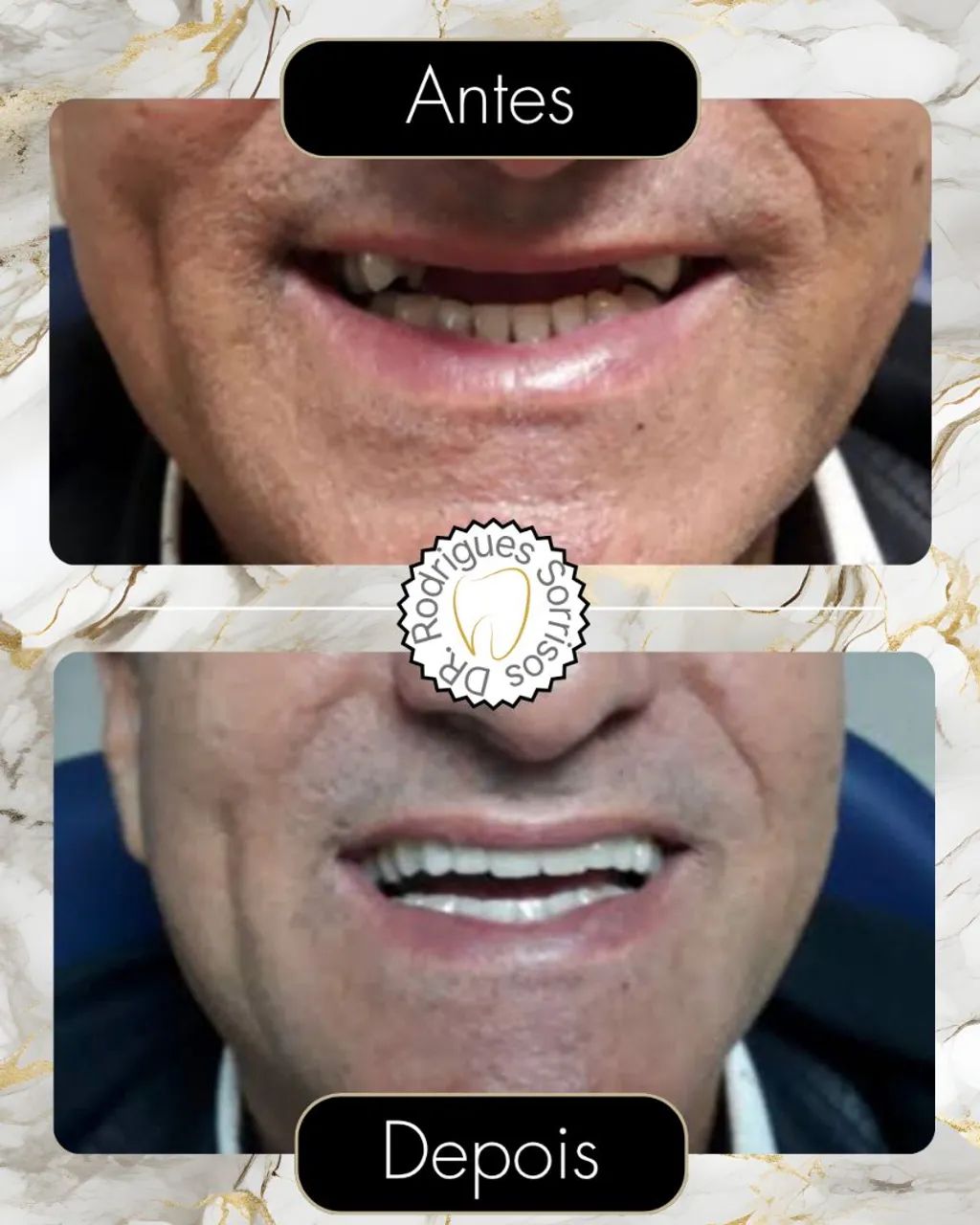 Dentadura direto com protético 
