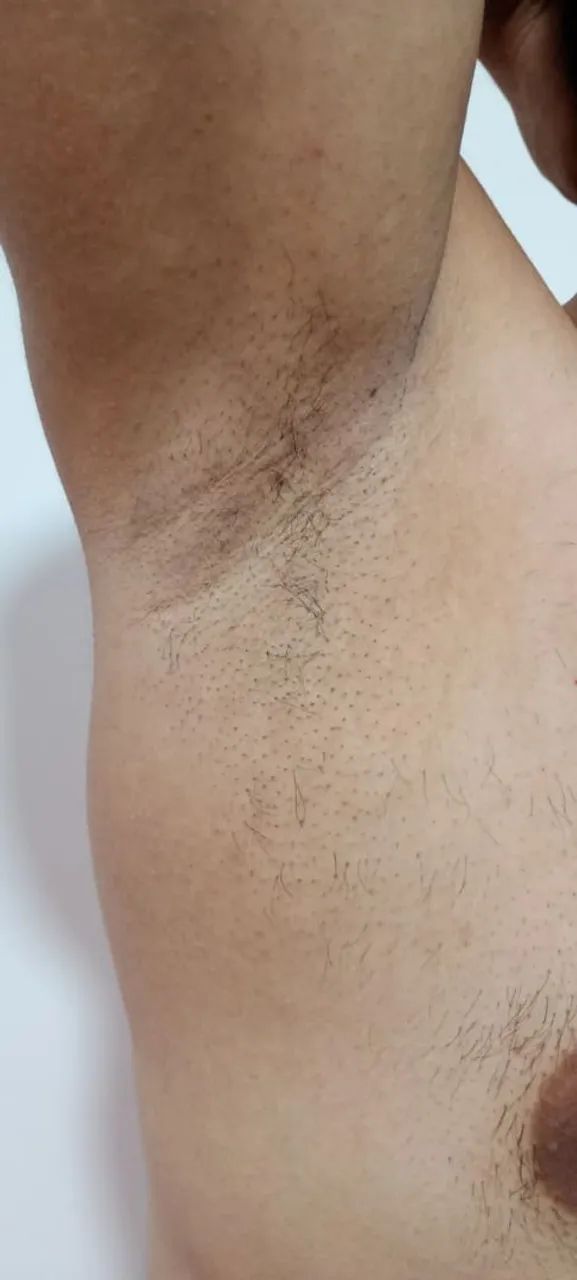 Depilação a Laser 