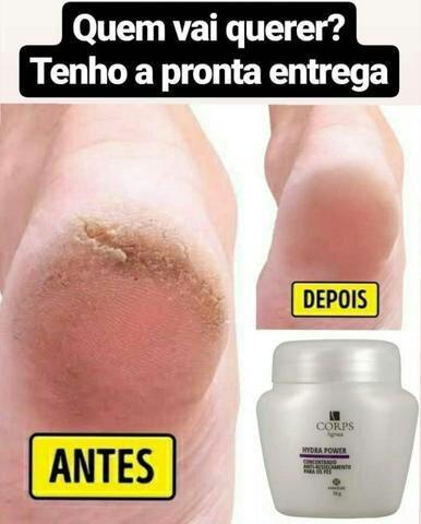 Eliminação total das rachaduras e o ressecamento nos pés - Foto 4