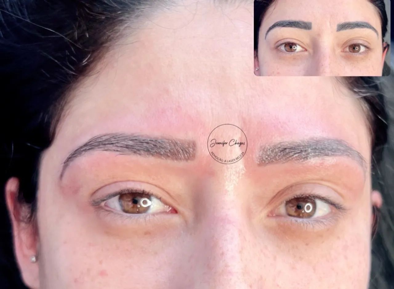 Remoção a laser de micropigmentação e tatuagem  - Foto 2