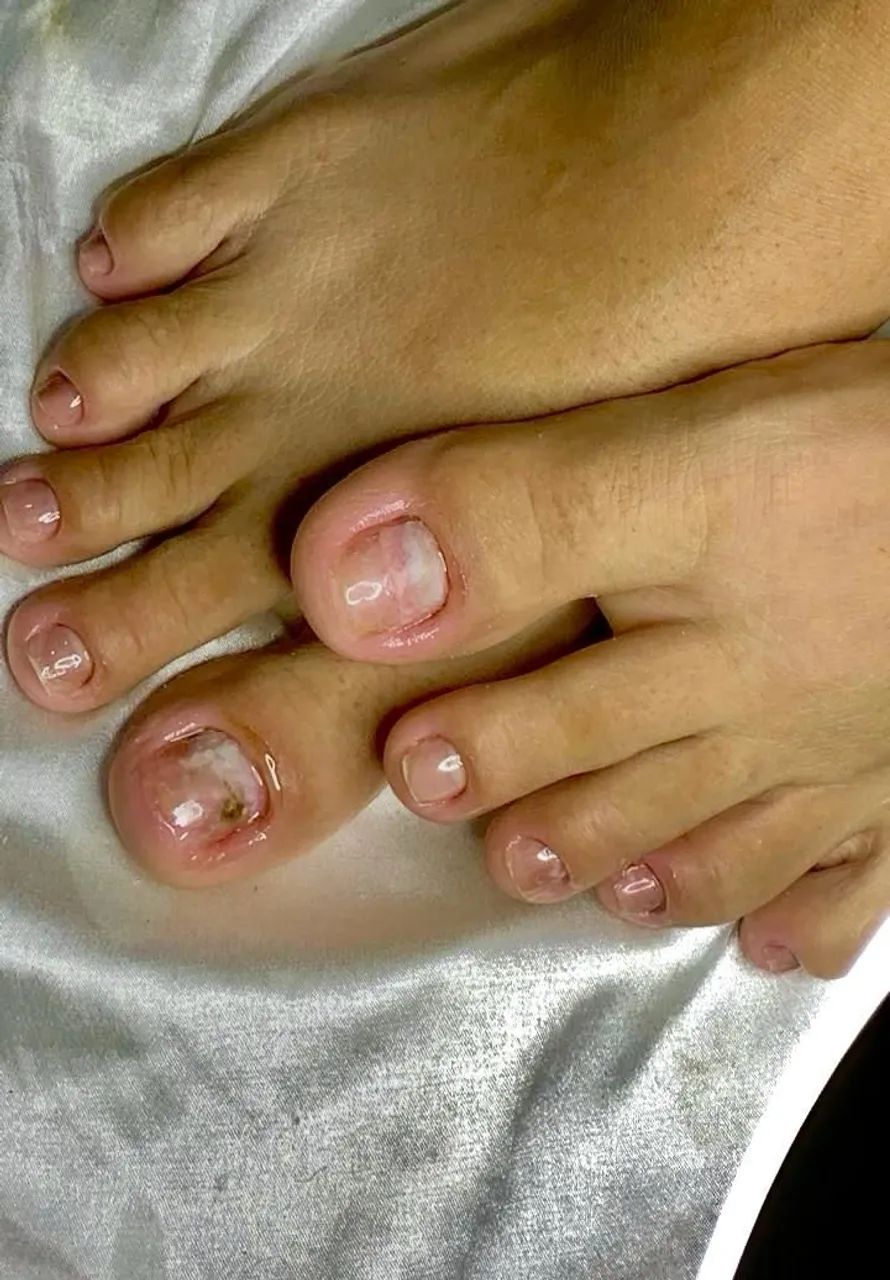PEDICIRE+BLINDAGEM NAS UNHAS - Foto 5