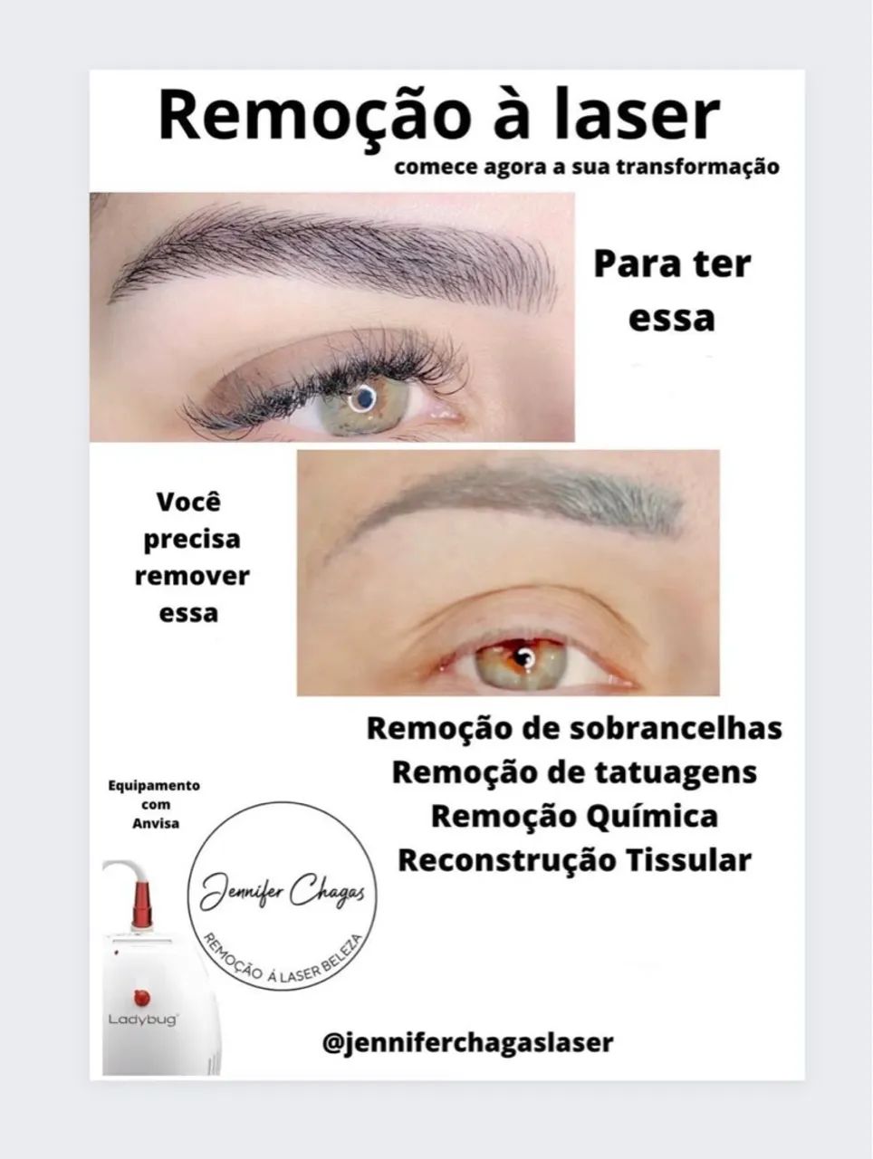 Remoção a laser de micropigmentação e tatuagem 