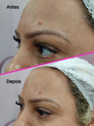 Remoção de Sinal - Foto 3