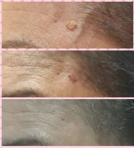 Remoção de Sinal - Foto 2