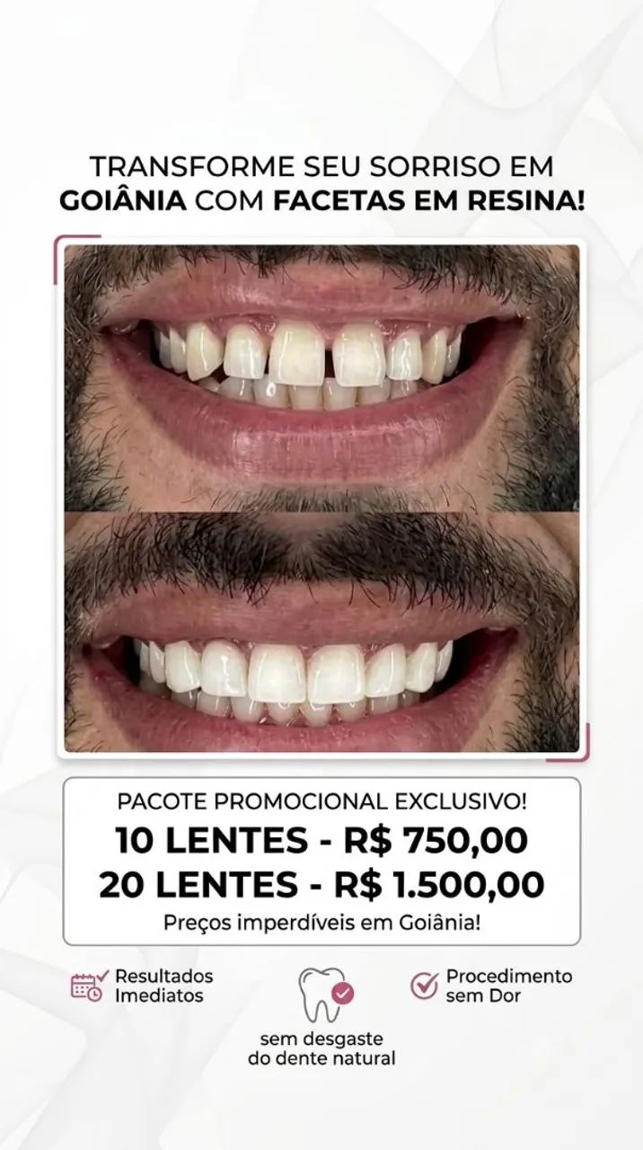 Facetas em Resina Premium