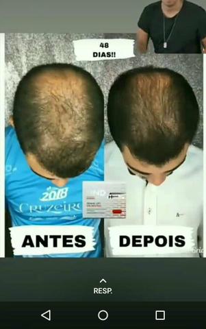 Crescimento de cabelo ou barba - Foto 2