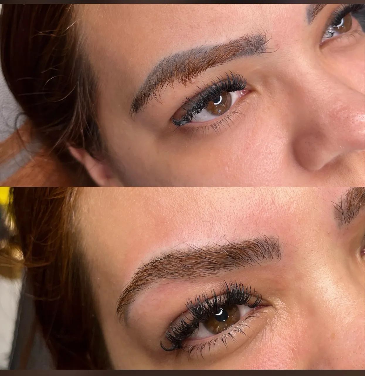 Remoção de micropigmentação 