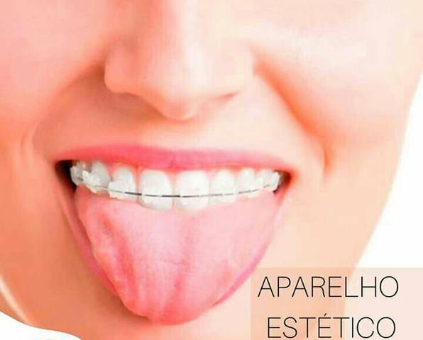 Aparelho Estético e Aparelho Metálico - Foto 4