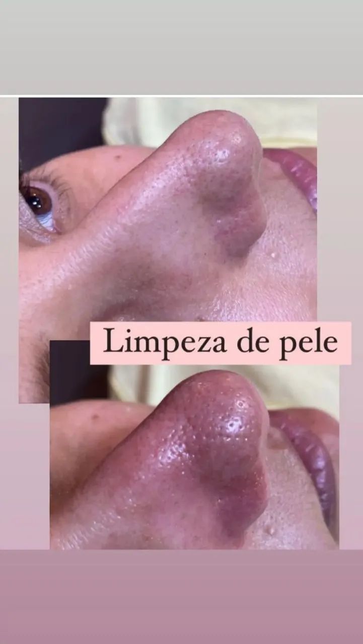 Limpeza de pele  - Foto 2