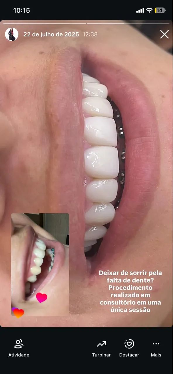 Facetas em resina  - Foto 2