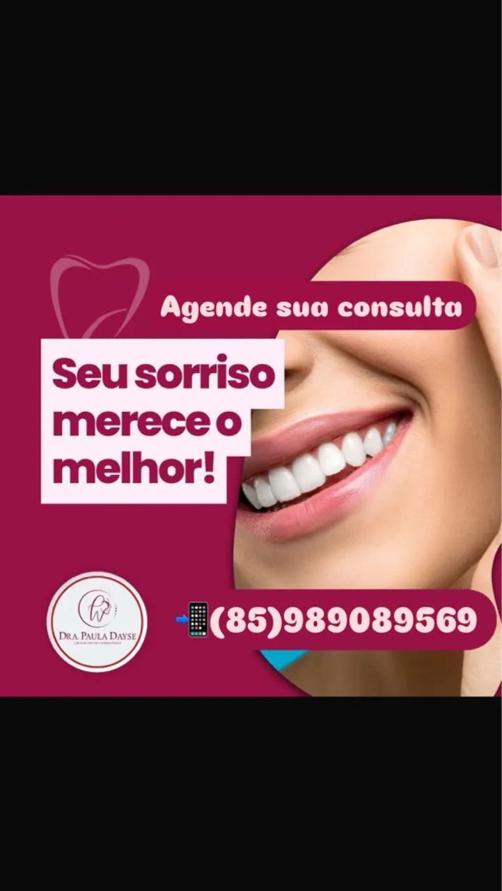 Facetas de Resina composta  - Foto 4