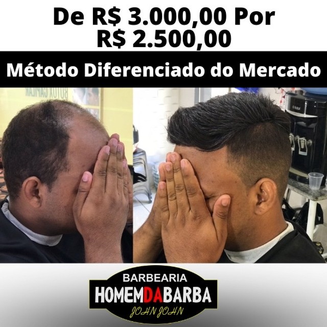 Prótese capilar em São Luís - Maranhão 