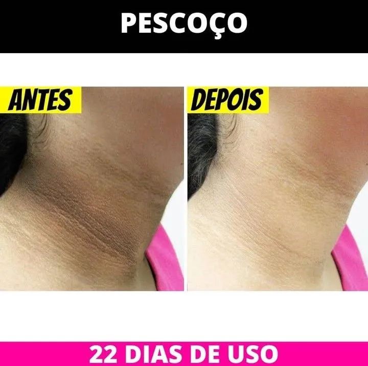 [ clareador de manchas de pele] [ pele saudável ] - Foto 4