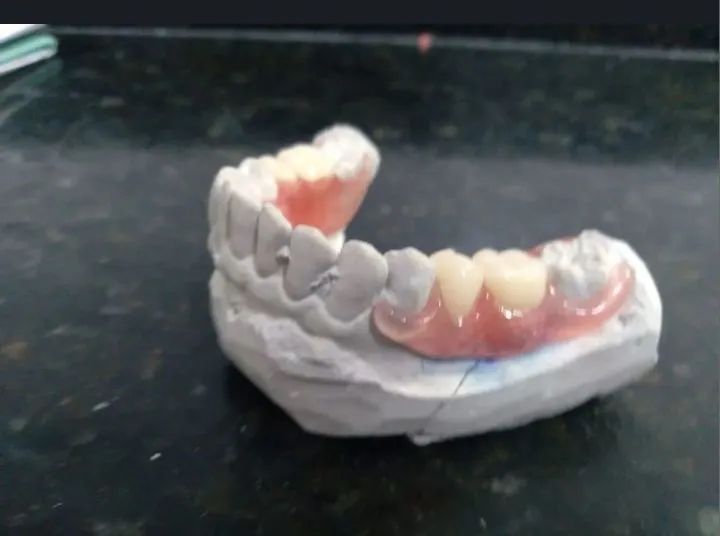 Prótese Dentária a partir de 200 reais  - Foto 4