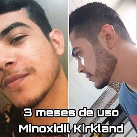 Minoxdil - Foto 5