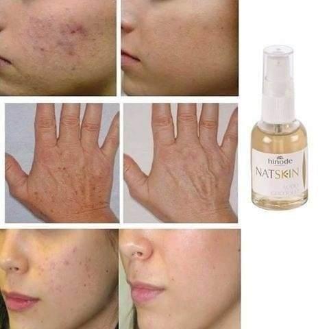 Natsklin Ácido Glicolico 30ml - acabe com o melasma e manchas no rosto