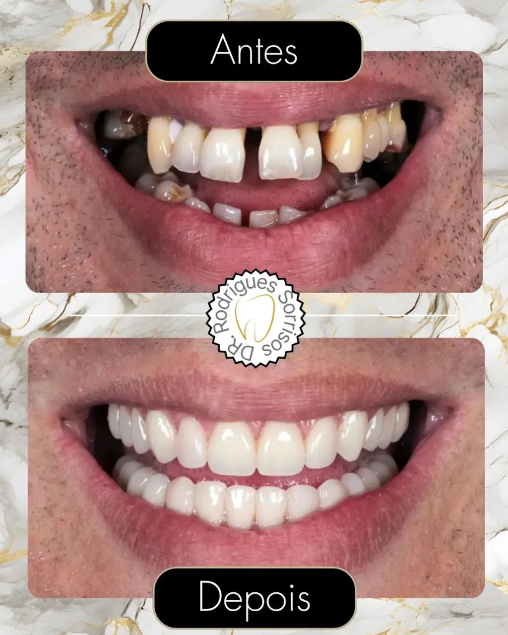 Dentadura direto com protético  - Foto 2