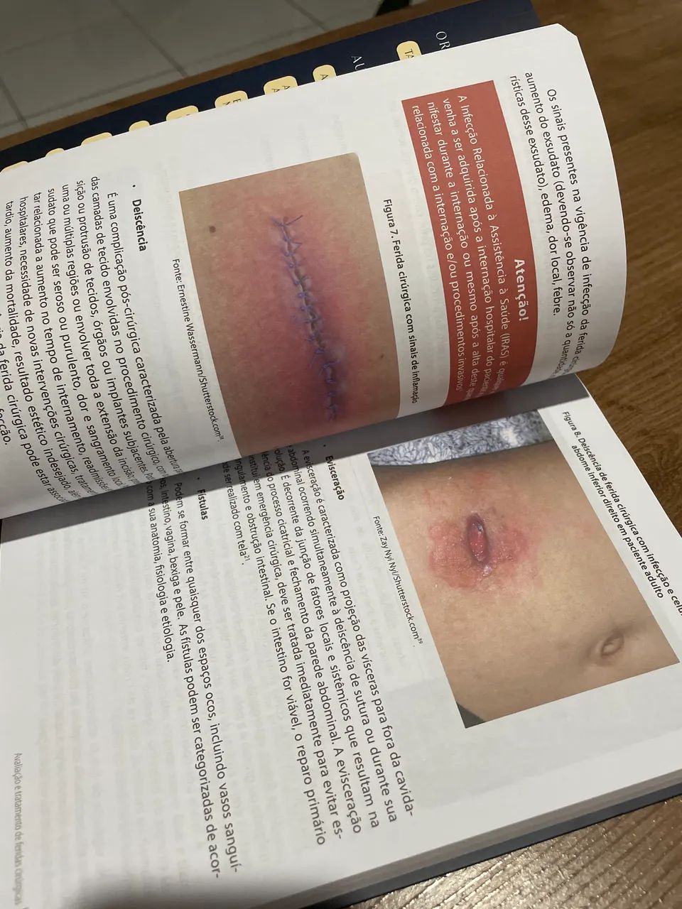 Prevenção e tratamento de feridas SANAR - Foto 2