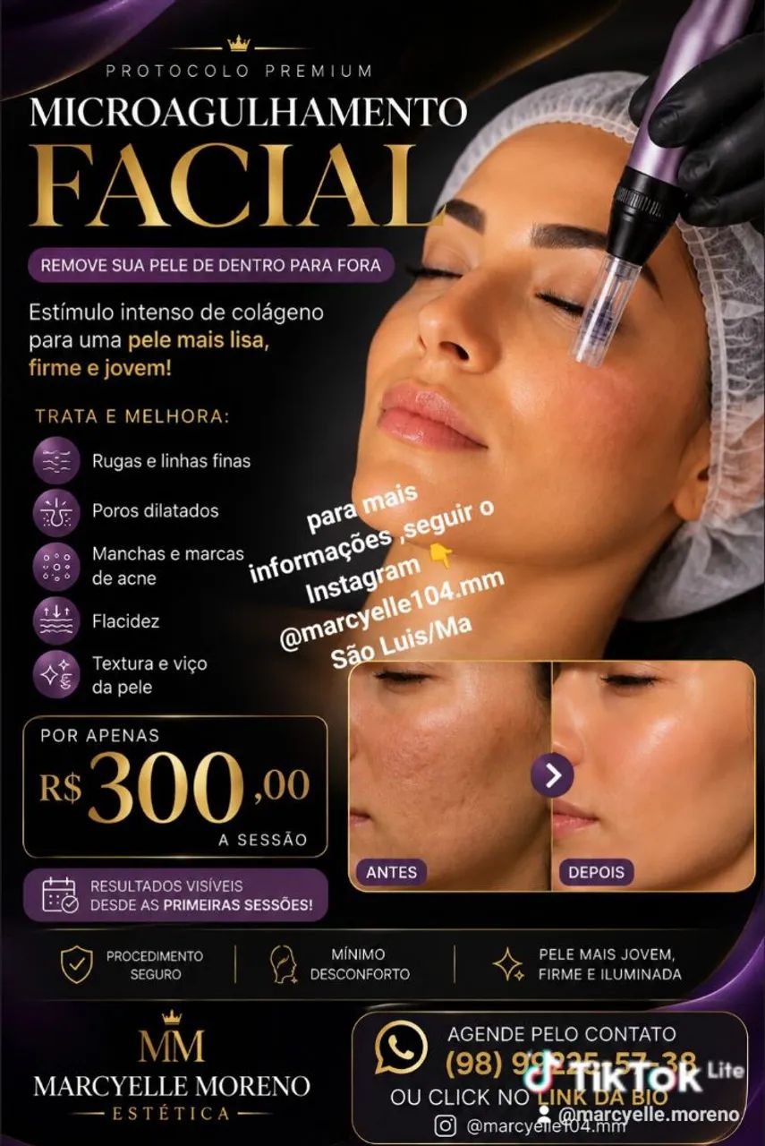 Microagulhamento 