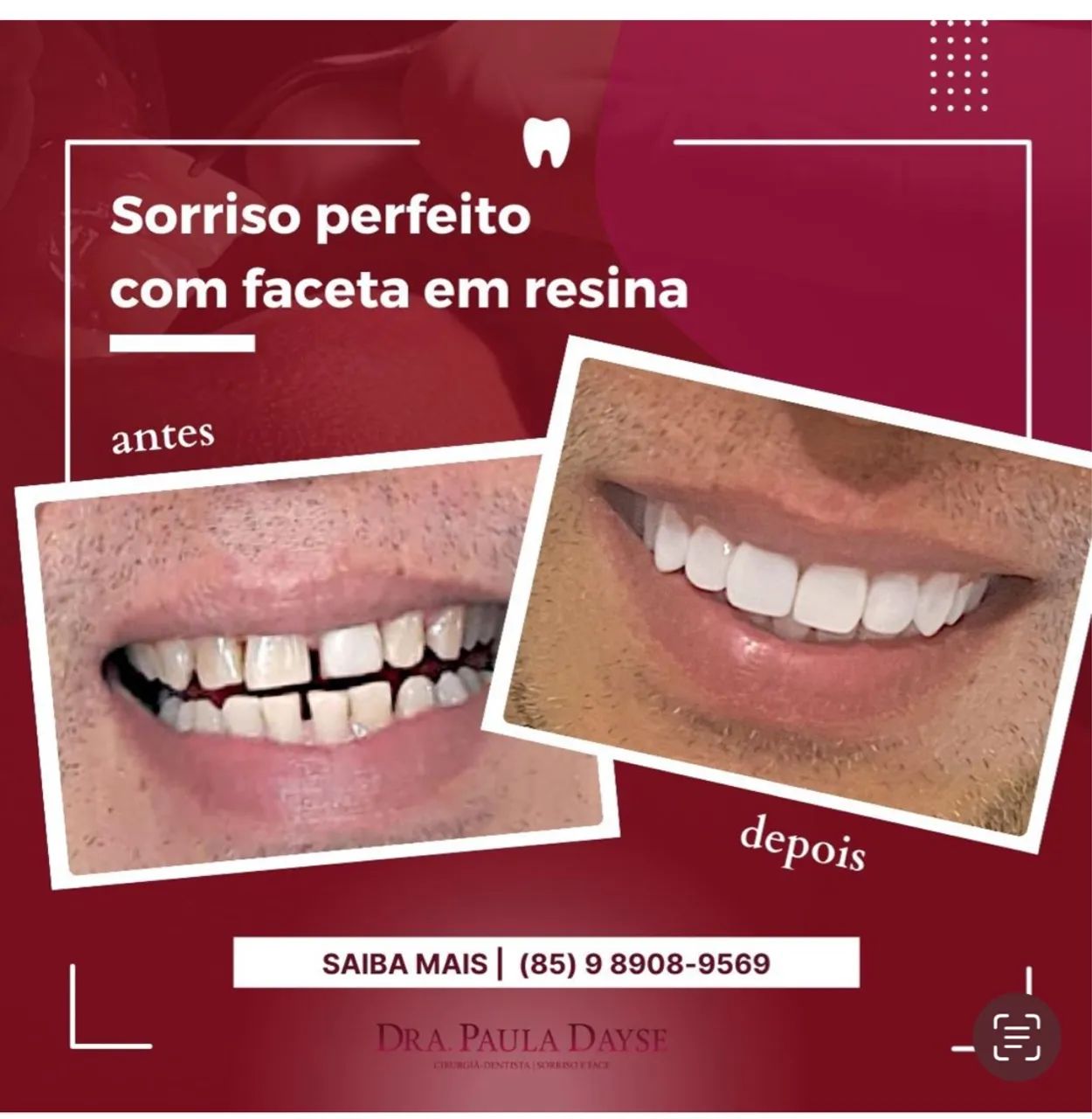 Facetas de Resina composta  - Foto 2
