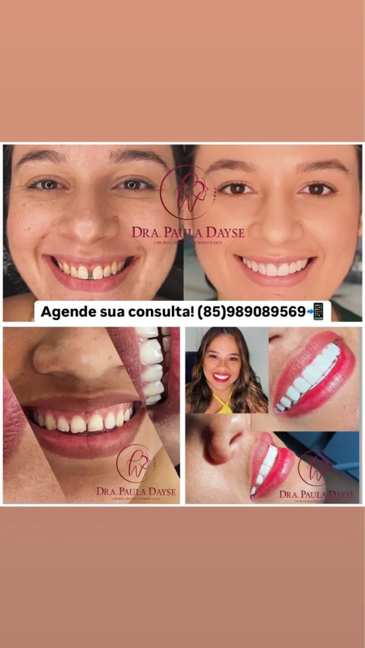 Facetas de Resina composta 