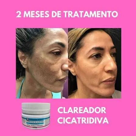 [ clareador de manchas de pele] [ pele saudável ] - Foto 3