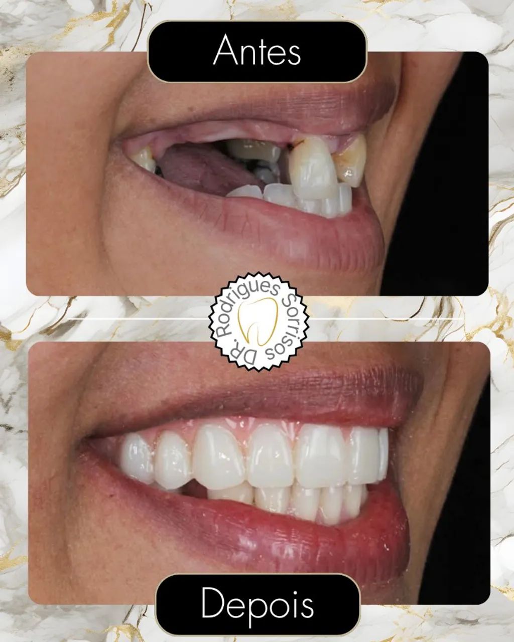 Dentadura direto com protético  - Foto 3