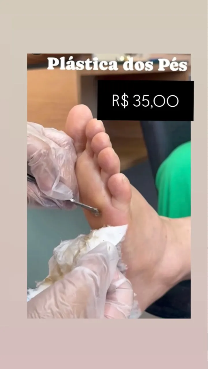Spa dos pés remoção de calos - R$35,00