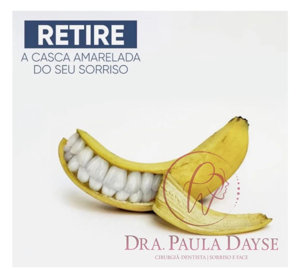 Facetas de Resina composta  - Foto 5