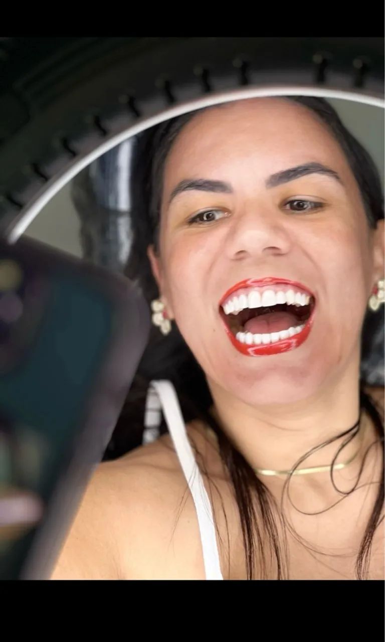 Facetas de Resina composta  - Foto 3