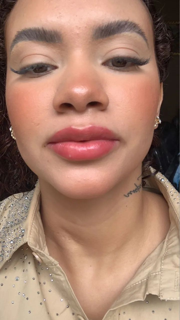 Estetica Preenchimento Labial  - Foto 5