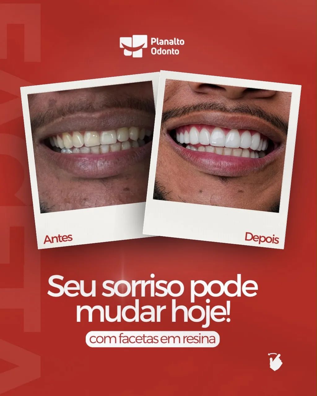 Dentista, faceta em resina