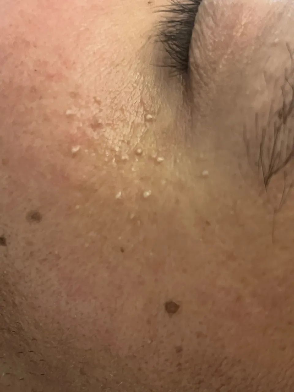 Limpeza de pele profissional  - Foto 3