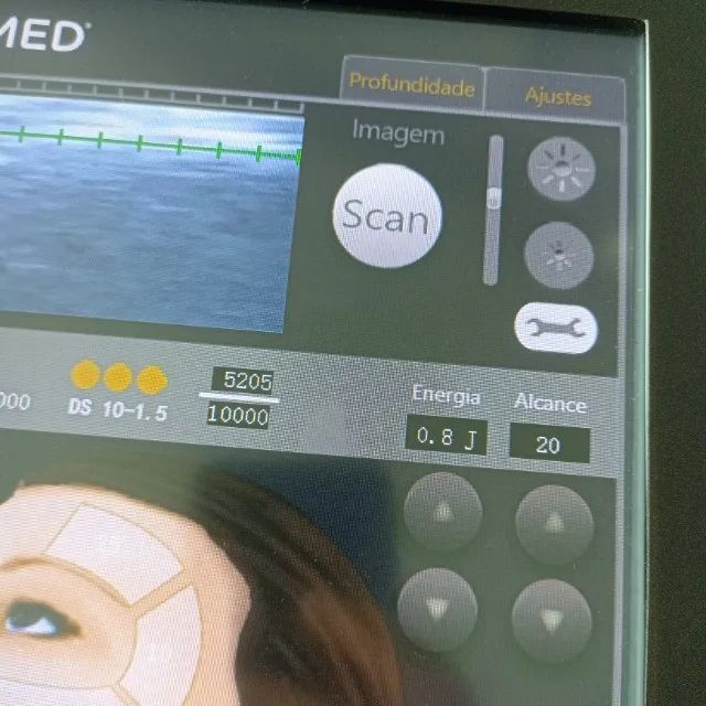 Ultramed HIFU Ultrassom Micro e Macrofocado Com 5 Cartuchos - Foto 4