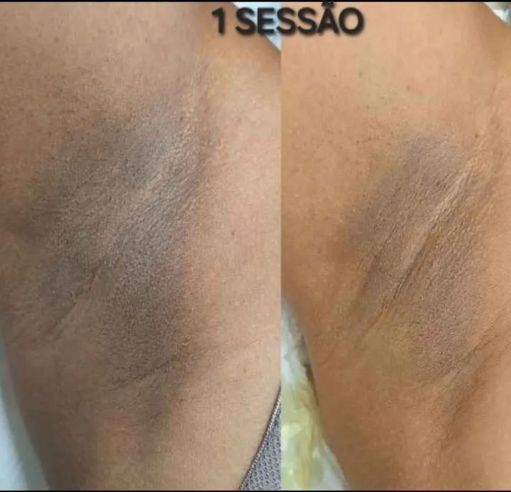 Clareamento de Manchas: LIBERTE-SE!