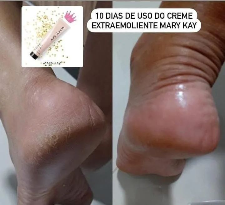 Sofre com pés e mãos ressecadas? Extraemoliente noturno da MARY - Foto 5