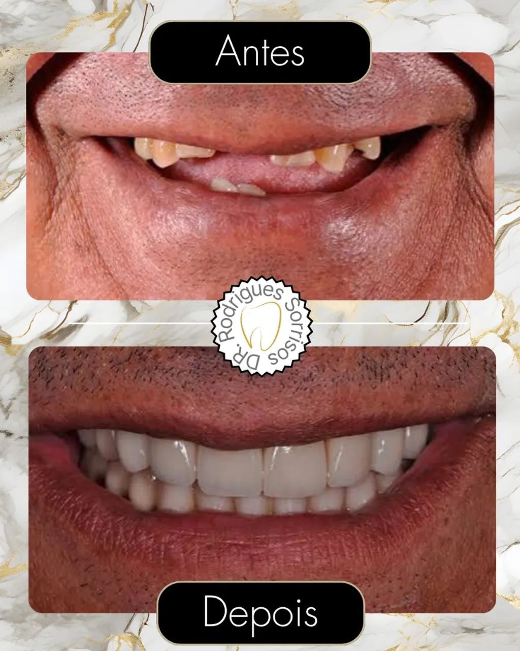 Dentadura direto com protético  - Foto 4
