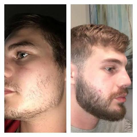 Promoção Minoxidil 5% ORIGINAL - Foto 2