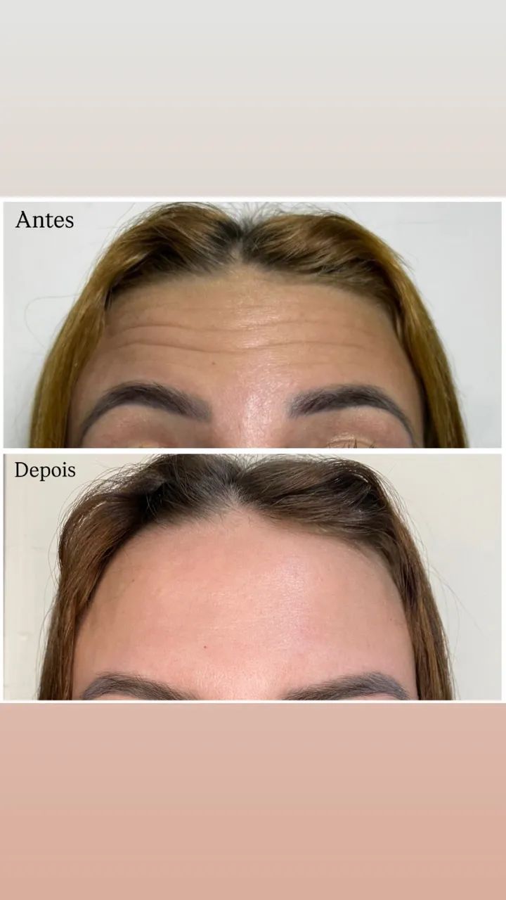 Toxina botulínica  - Foto 2