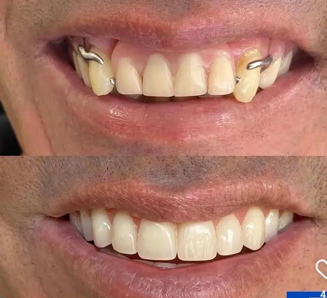 Prótese dentária - Foto 2