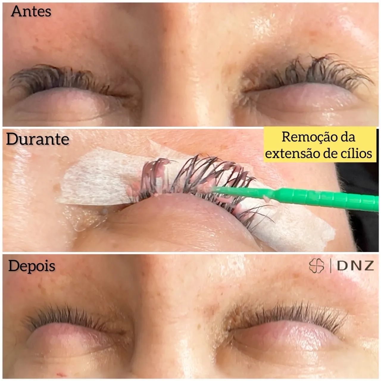 Remoção de extensão de cílios 