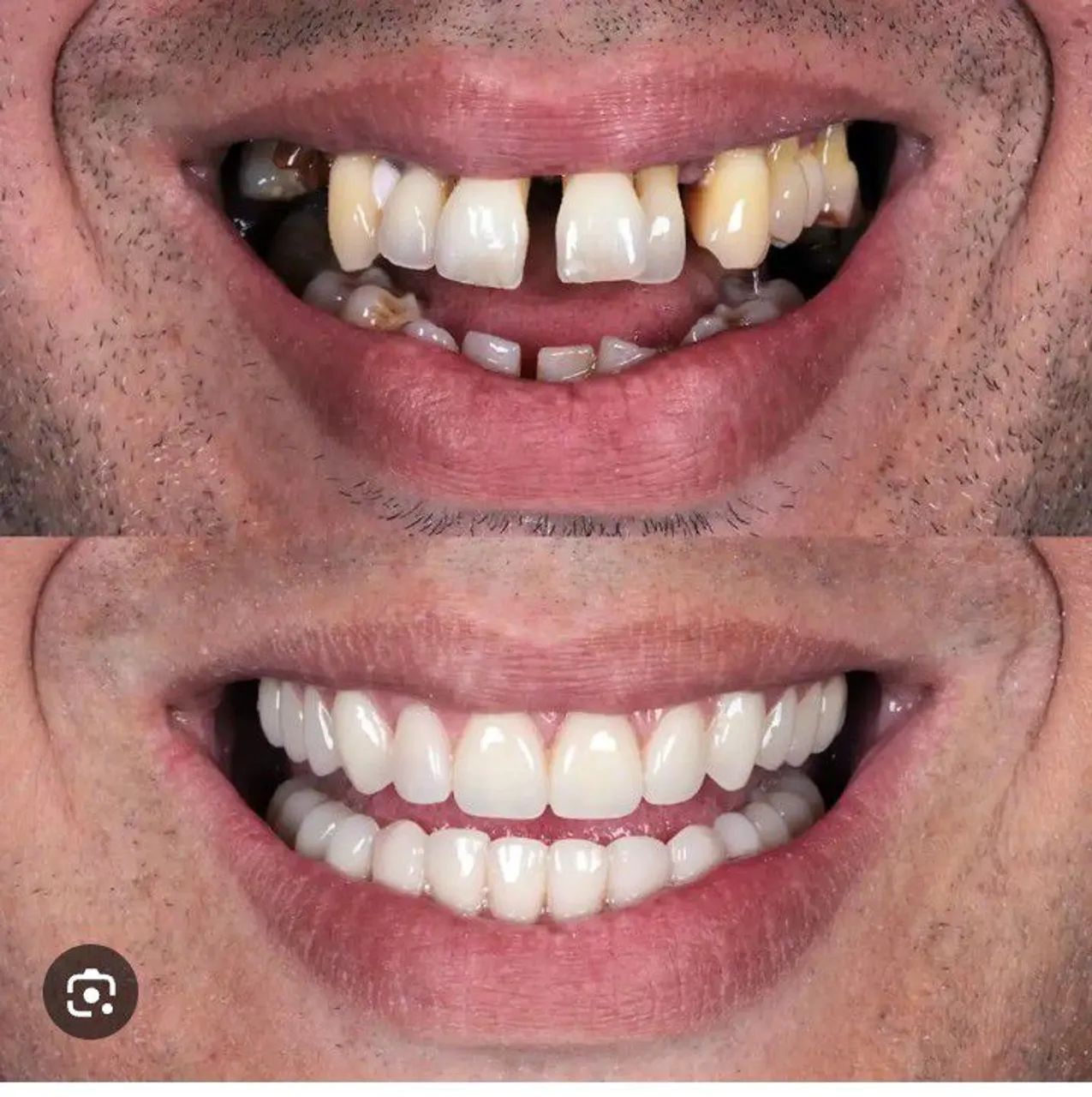 Prótese dentária - Foto 3