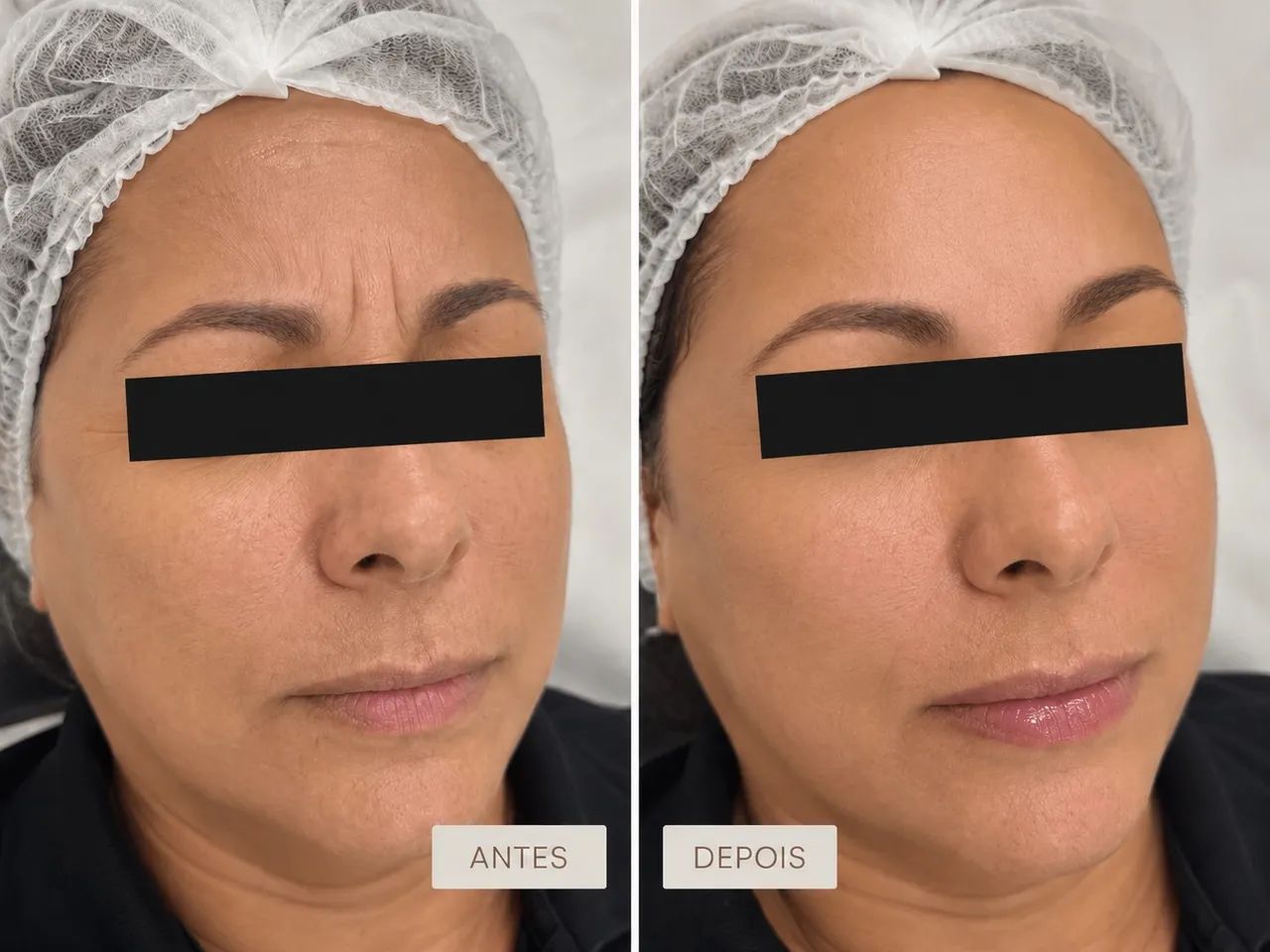 VAGAS PARA PACIENTES MODELO BOTOX - Foto 2
