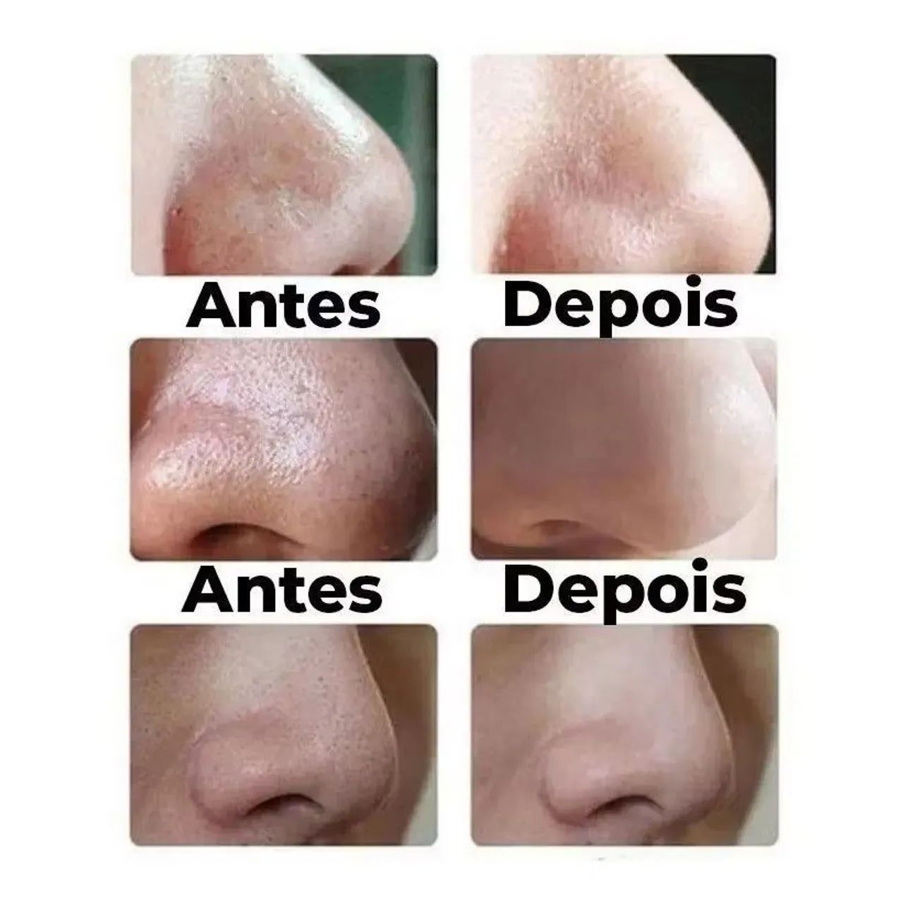 Kit de ferramentas tirar cravos acnes e espinhas em aço inoxidável - Foto 4