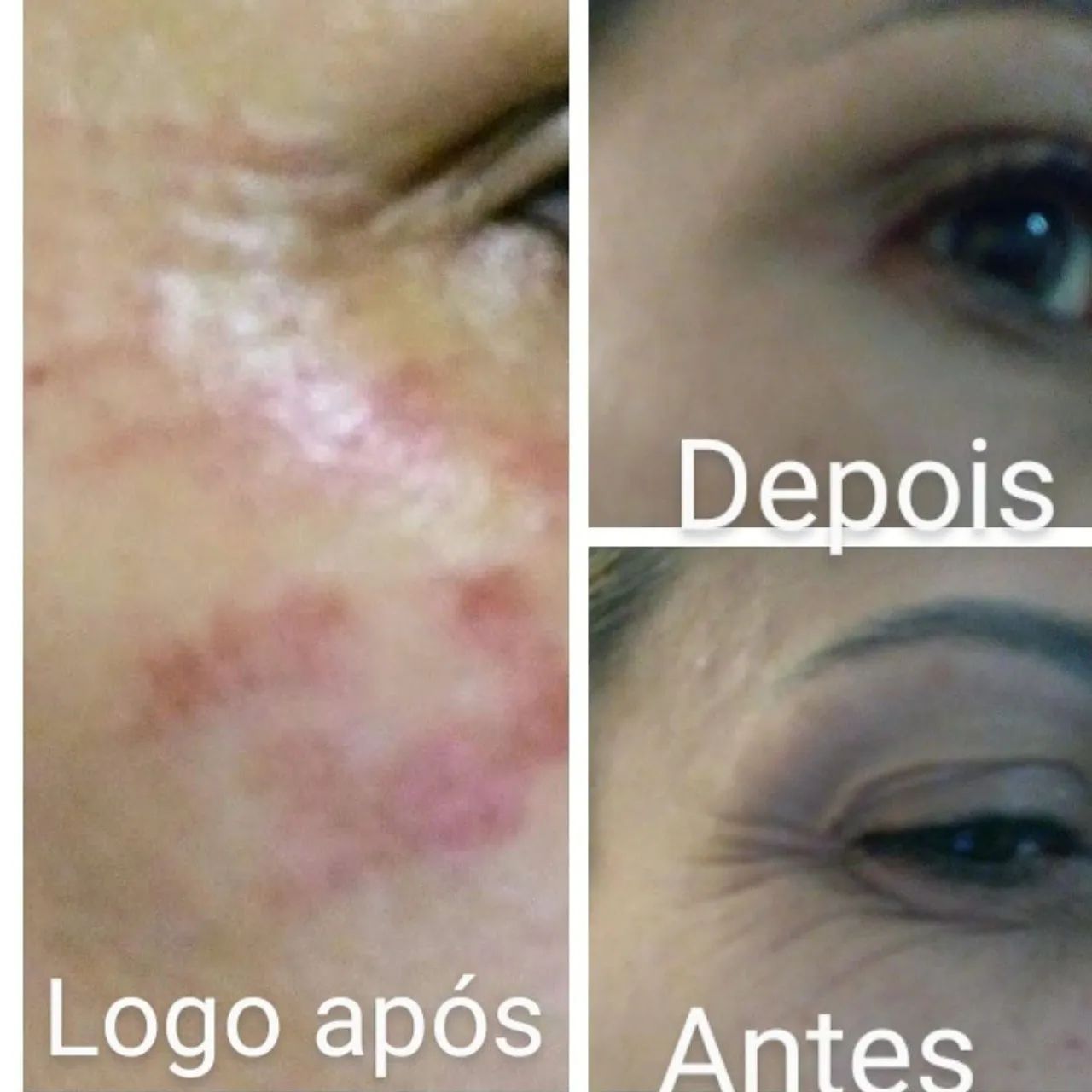 Promoção relâmpago. Quer retirar verrugas, sinais, aplicação de Jato. 